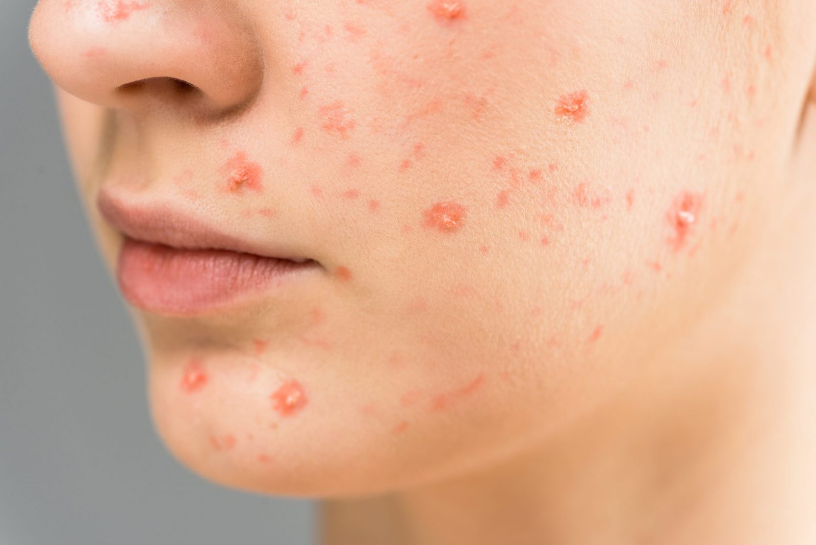 girl's face with acne