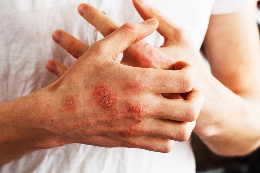 Man Scratching Dry Flaky Hands caused by Eczema